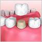 core buildup dental