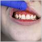 coronavirus gum disease