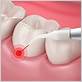 cost of laser treatment for gum disease