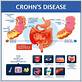 crohn's disease and gum inflammation