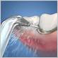 crown chipped at gum line after using waterpik