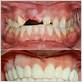 crowns with gum disease