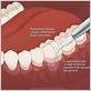 cure for periodontal disease