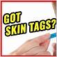 cutting off skin tags with dental floss