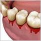 dangers of untreated gum disease