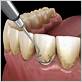 deep cleaning and gum disease