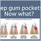 deep gum pockets treatment