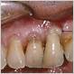 define gum disease disease