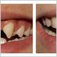 dental bonding after gum disease