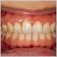 dental braces gum diseases