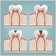 dental crown pain when chewing