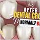 dental crown sensitive to chewing