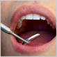 dental exam poked chewing surface