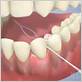 dental floss for bridge teeth