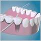 dental floss for fixed bridge