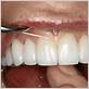 dental floss goes under gums