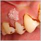 dental floss papilloma