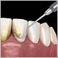 dental floss plaque removal
