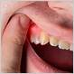 dental gum disease hurst tx