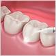 dental gum treatment