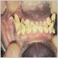 dental hypoplasia chews in dog