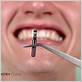 dental implant cant chew