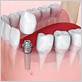 dental implant crown cannot chew