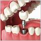 dental implants can feel the screw with floss