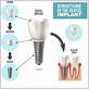 dental implants how does it work