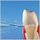 dental implants oral irrigation