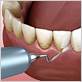 dental insurance for gum disease