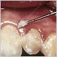 dental plaque and gum disease