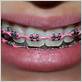 dental power chain braces