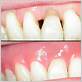 dental veneers gum disease