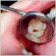 dental visits gum disease cavities