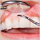 dentist for severe gum disease everett washington dental delta