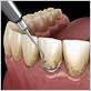 dentist near me gum disease implants