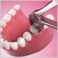 dentist recommends molar removal for gum disease
