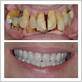 dentures after gum disease