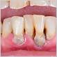 dentures because of gum disease