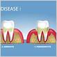 des moines gum disease