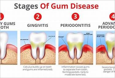 developing gum disease