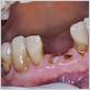 diagnosed with gum disease in 20's has 4 molars pulled