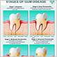 different stages of gum disease