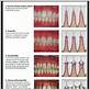 different types of gum disease