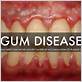 dip gum disease denial
