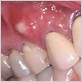 disease causing whrite growths on gums