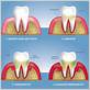 disease destroys the gums and ligaments that surround the teeth