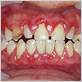 disease in the gums