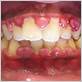 disease of sailors gums